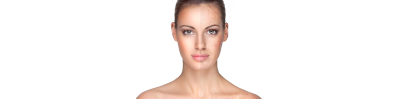 How can you REALLY get rid of brown spots and uneven pigmentation?