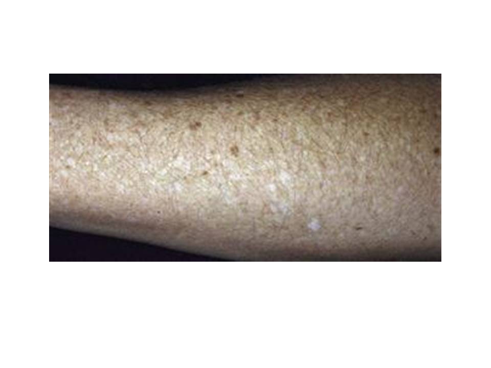 White ‘freckles’ on my arms – what are they?? 