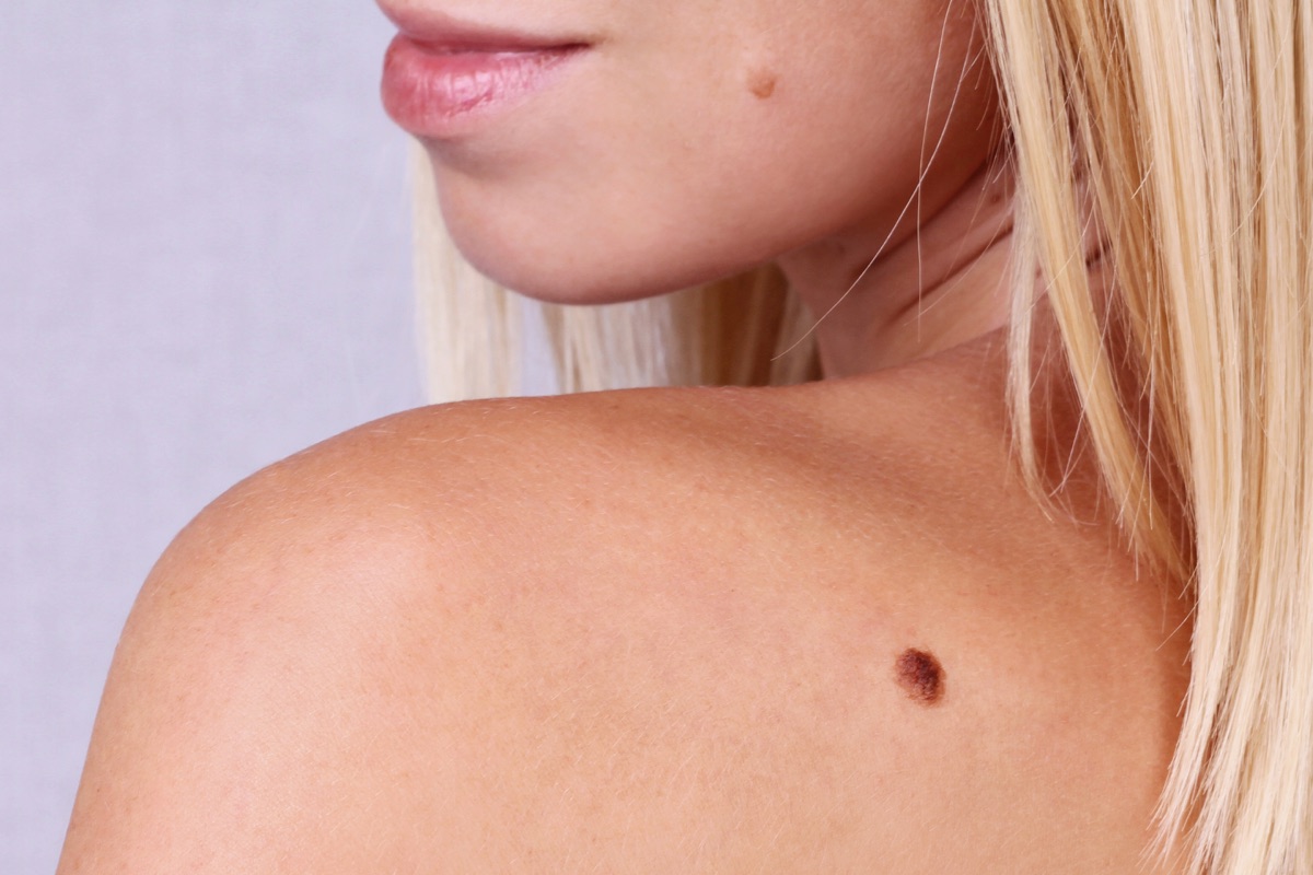 Skin damage and Mole Removal Clinic