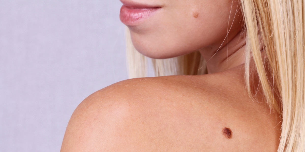 Eudelo Treatments for moles, skin cancer and sun damage