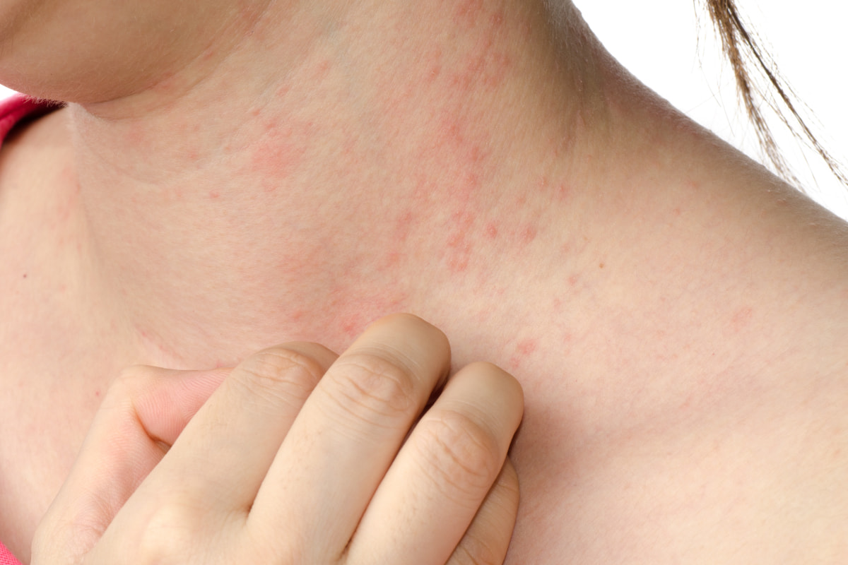 Eczema dermatitis