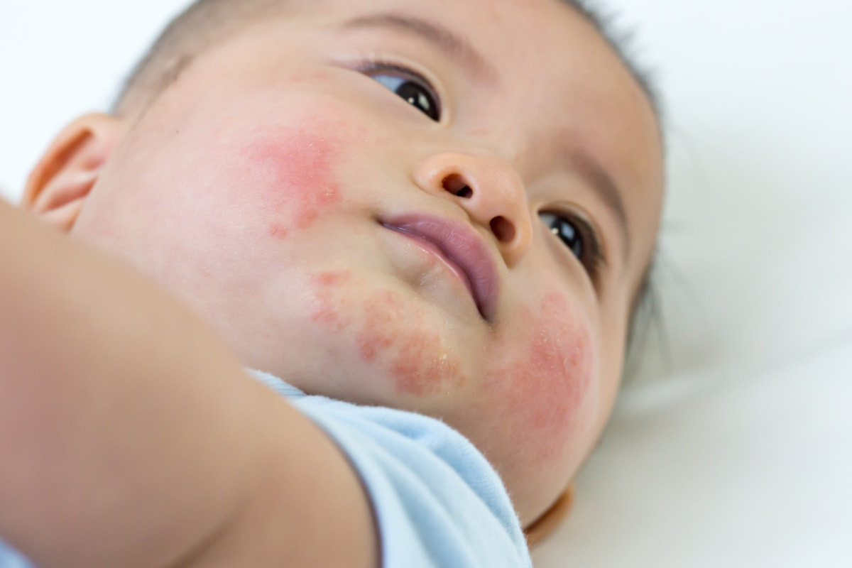 Eczema, dermatitis and other rashes