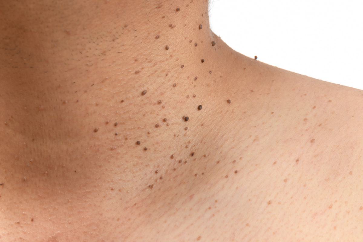 Moles Removal, Skin Cancer Checks and Sun Damage 