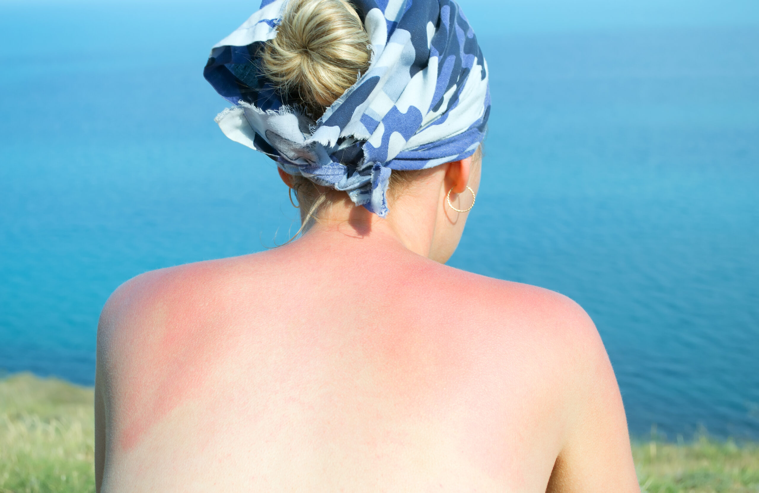 Best ways to treat sunburn on holiday